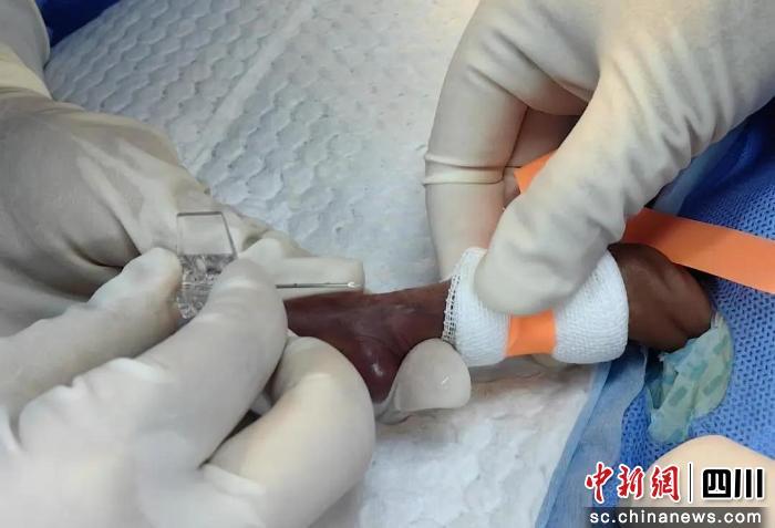 为超早产儿的救治打通细如发丝的“生命
